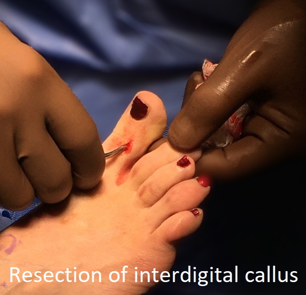 resection interdigital callus